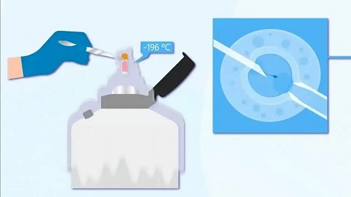 泰國試管胚胎移植方式有哪幾種